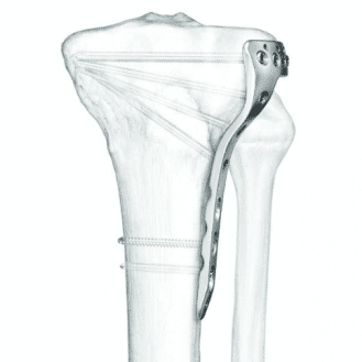 Choosing the Right Bone Plate